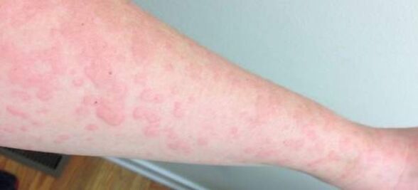 Alergie skórne są oznaką obecności pasożytów w organizmie